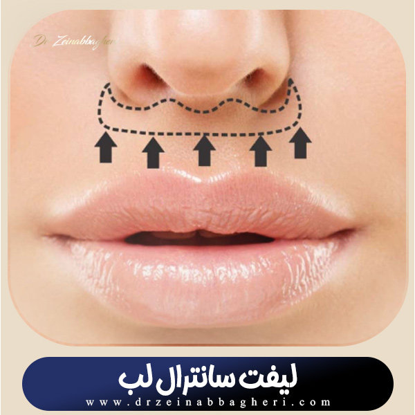 لیفت سانترال لب در تهران + دکتر زینب باقری