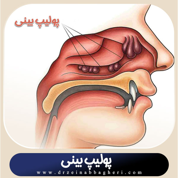 پولیپ بینی - دکتر زینب باقری