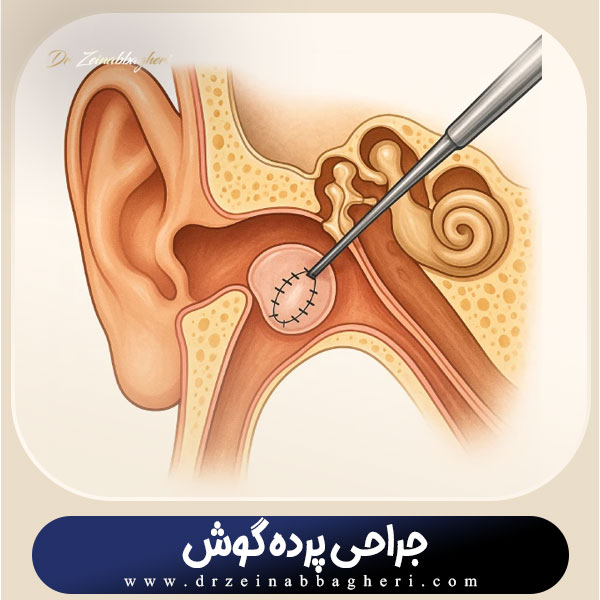 جراحی پرده گوش + دکتر زینب باقری