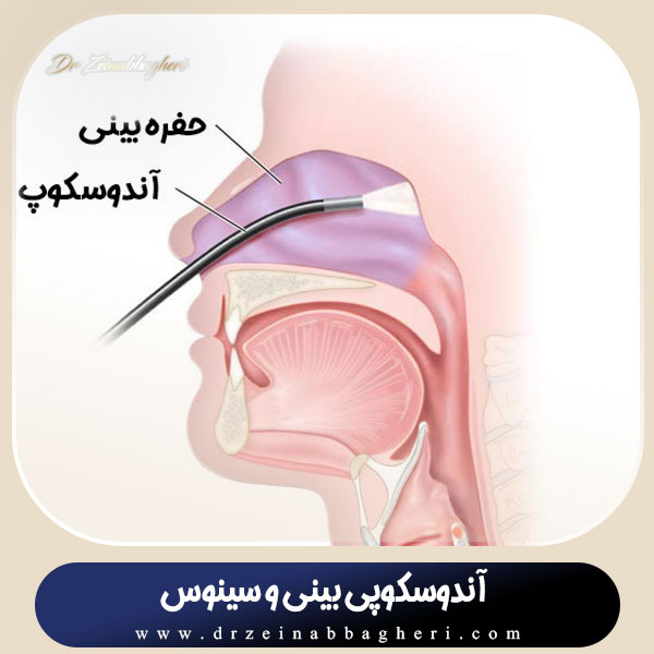آندوسکوپی بینی و سینوس + دکتر زینب باقری